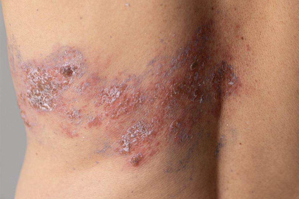 Stock image of a shingles rash. Getty